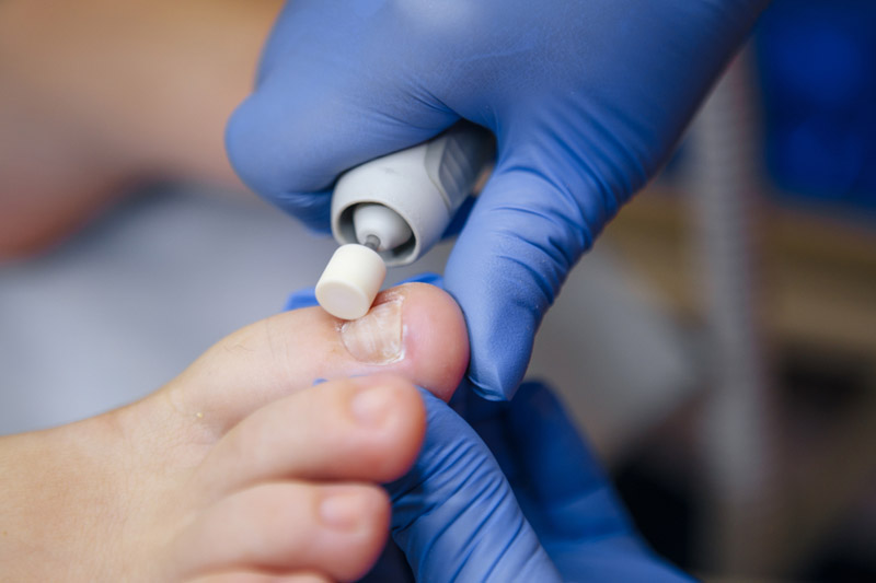 What Are Ingrown Toenails And How Can A Podiatrist Help With Them?